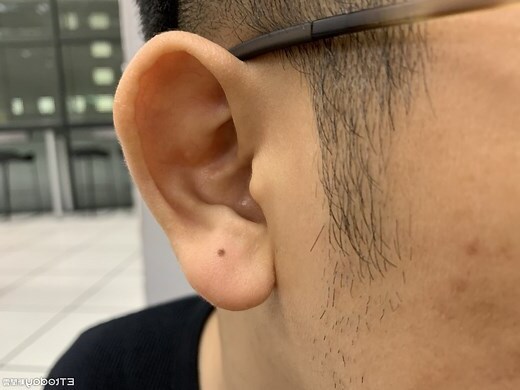 左耳 痣